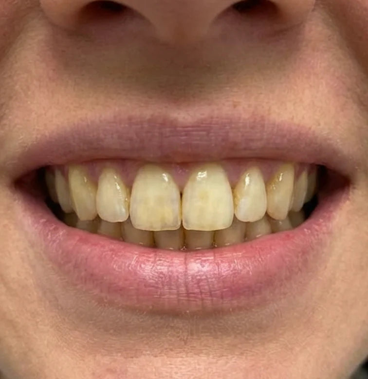 Before whitening