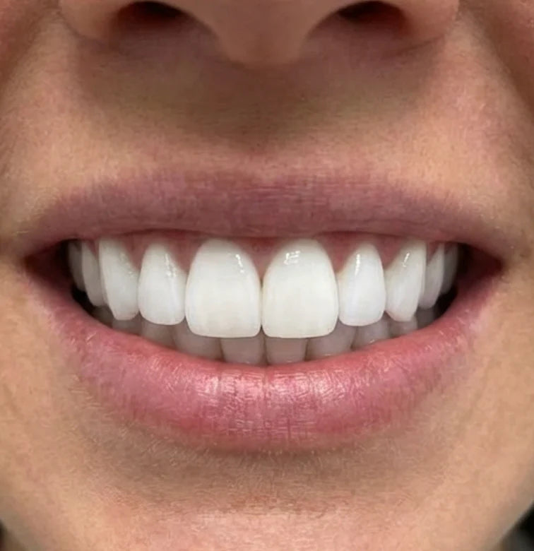 After whitening